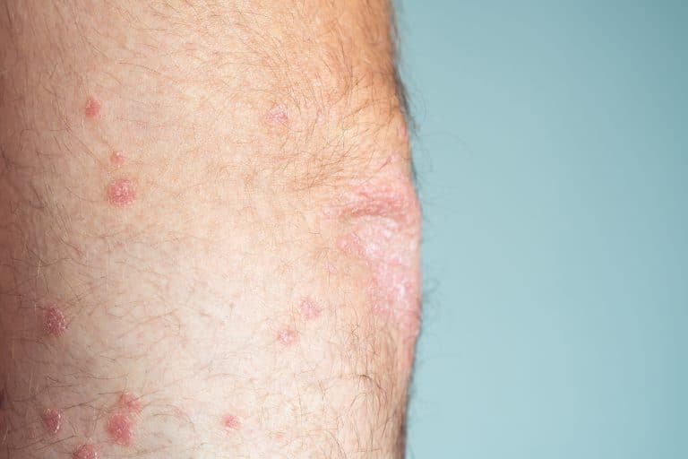 how to treat atopic dermatitis,