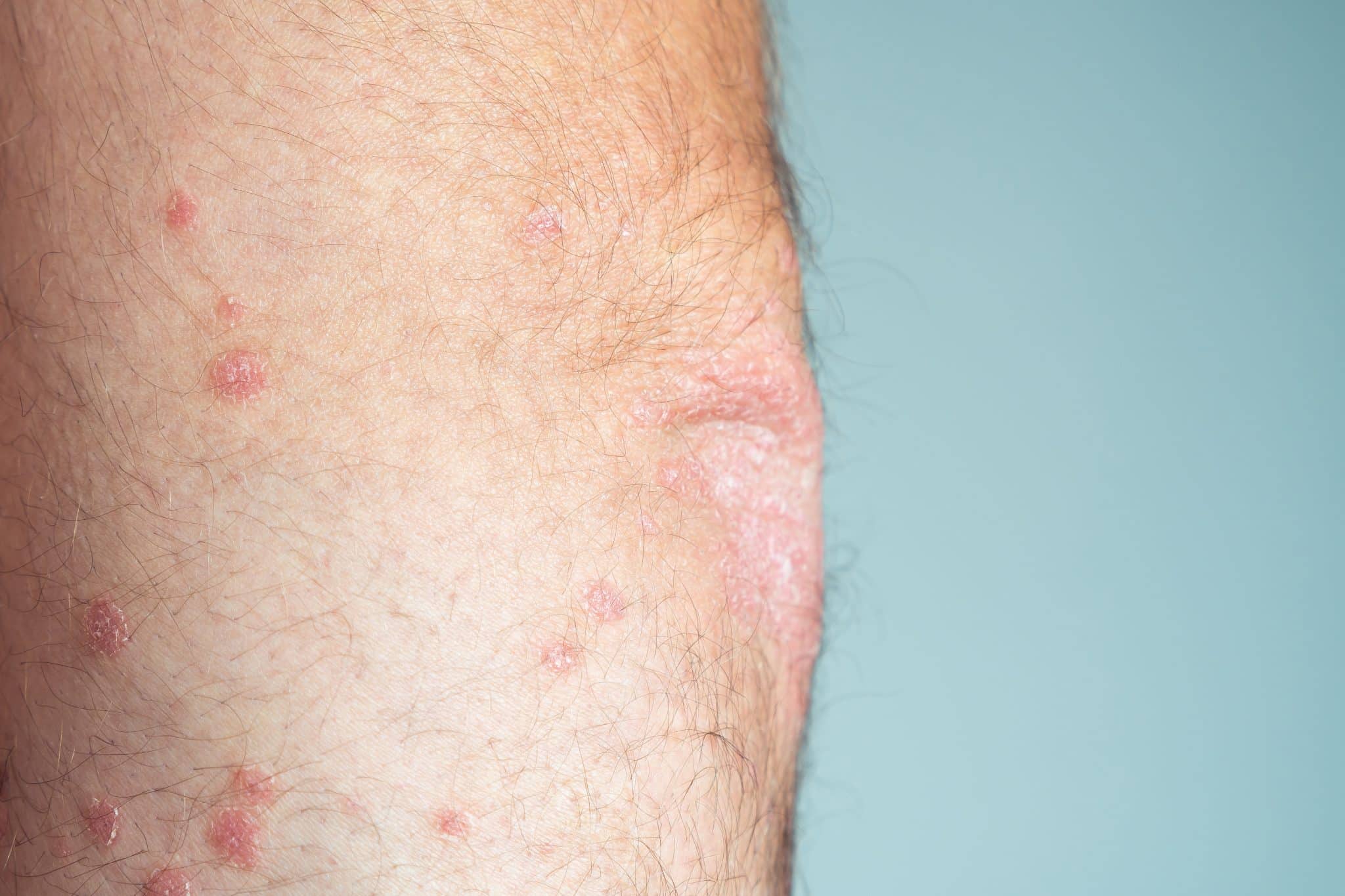 how to treat atopic dermatitis,