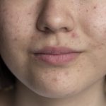 scars, is snail mucin good for acne scars,