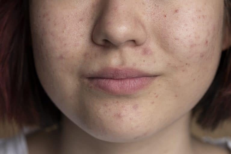 scars, is snail mucin good for acne scars,