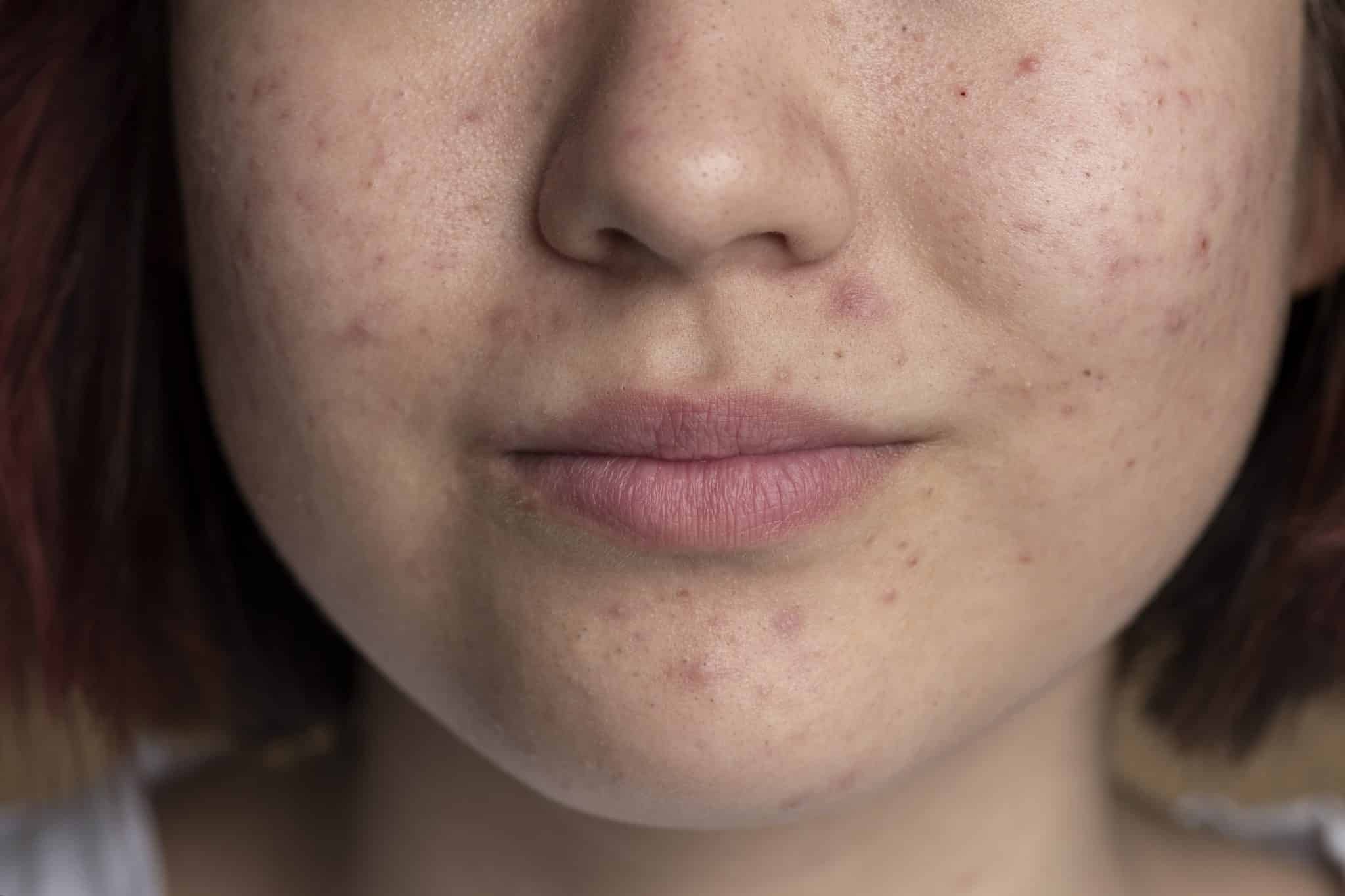 scars, is snail mucin good for acne scars,