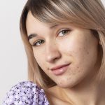 is snail mucin good for acne scarring,