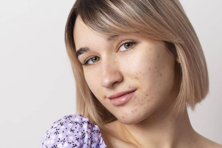 is snail mucin good for acne scarring,