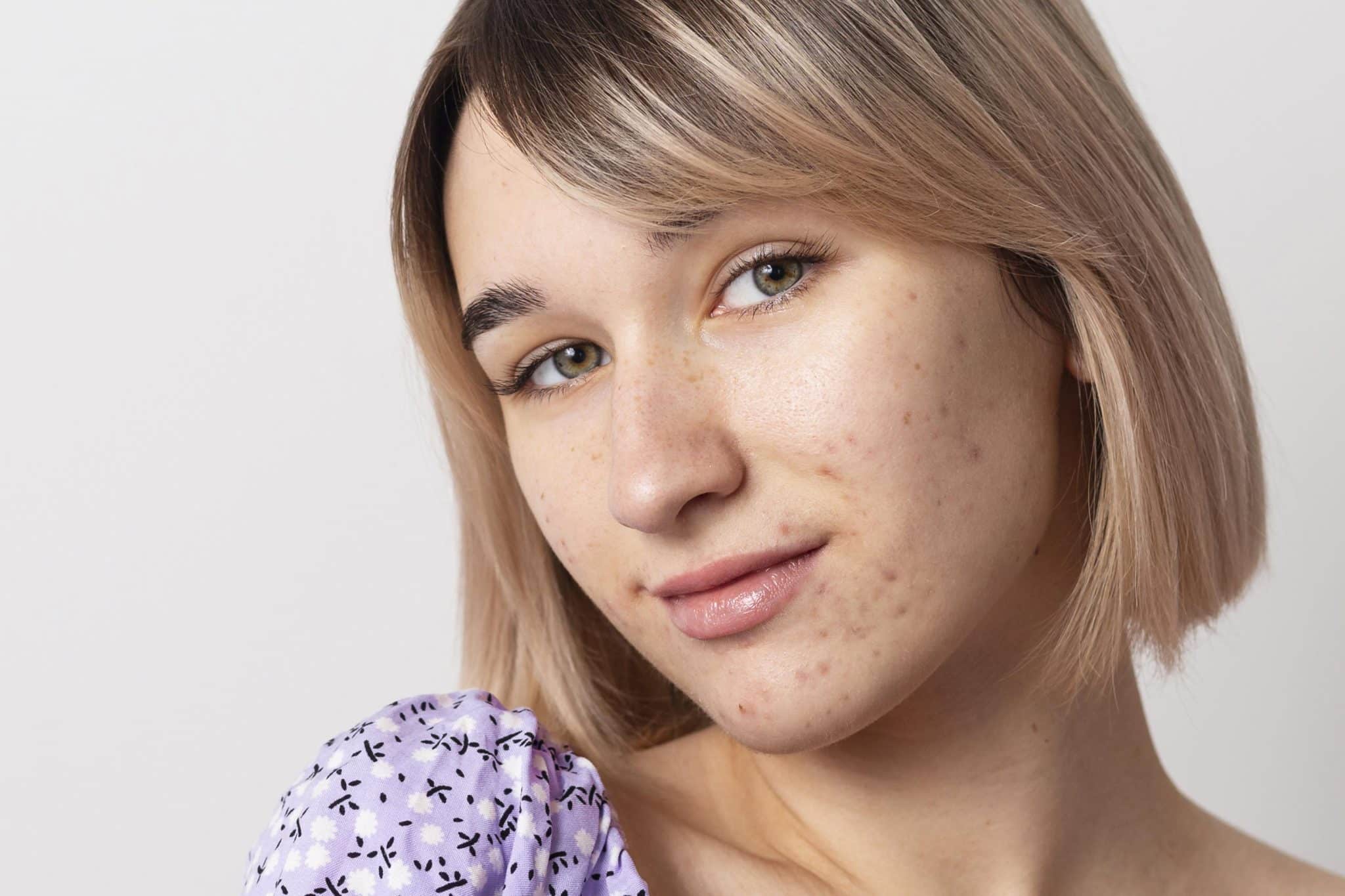 is snail mucin good for acne scarring,