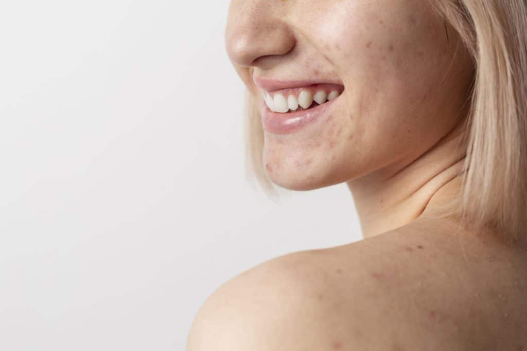 is snail mucin good for acne,