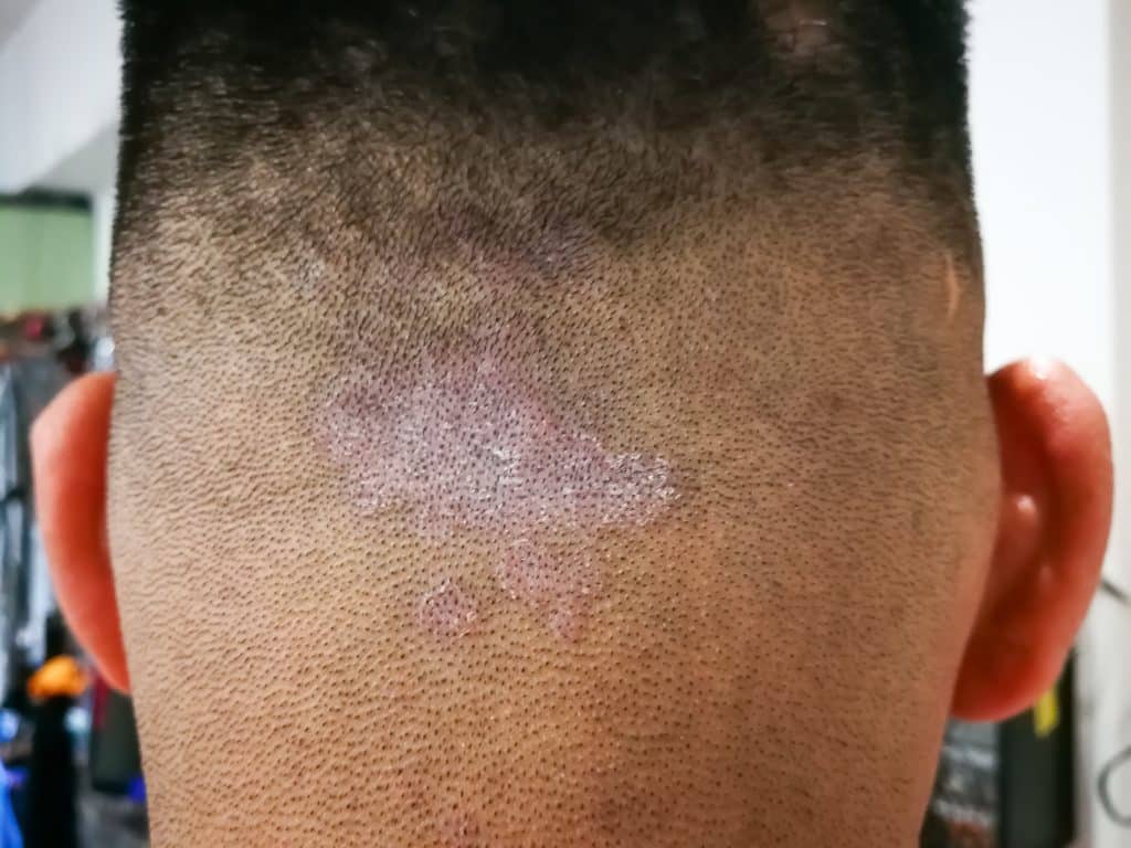 scalp psoriasis shampoo, psoriasis relief shampoo, medicated shampoo for scalp psoriasis, anti-itch shampoo for psoriasis, best shampoo for flaky scalp