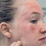 beast cream for seborrheic dermatitis , seborrheic dermatitis face cream, dermatitis on the face