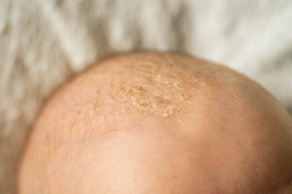 scalp psoriasis shampoo, psoriasis relief shampoo, medicated shampoo for scalp psoriasis, anti-itch shampoo for psoriasis, best shampoo for flaky scalp, shampoo for psoriasis on scalp,