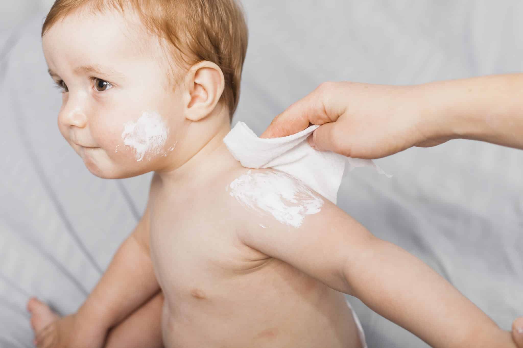 eczemA cream,dermatitis in infants, infant eczema cream