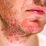 dermatitis on chin,