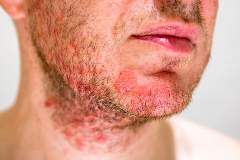 dermatitis on chin,