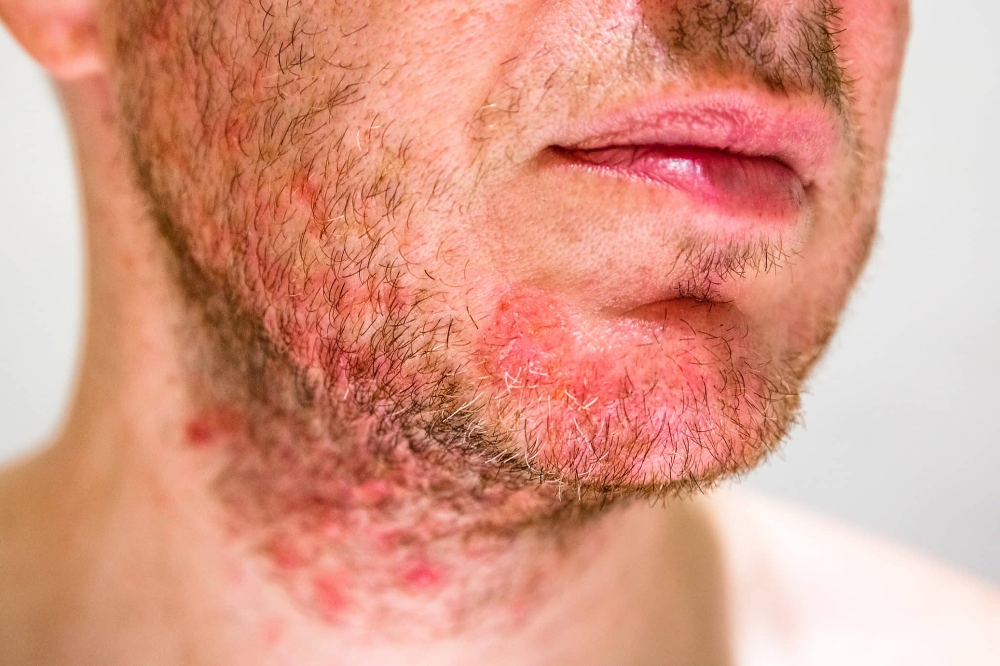 dermatitis on chin,