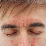 Psoriasis Cream, dermatitis treatment cream, eczema on face,