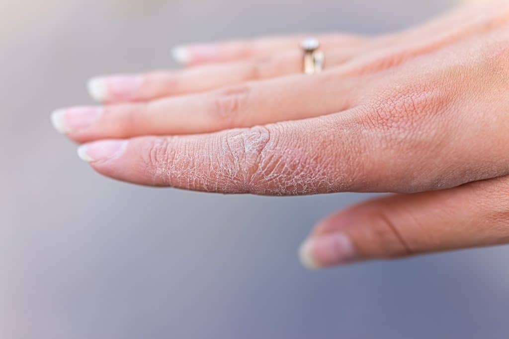 atopic dermatitis on hands