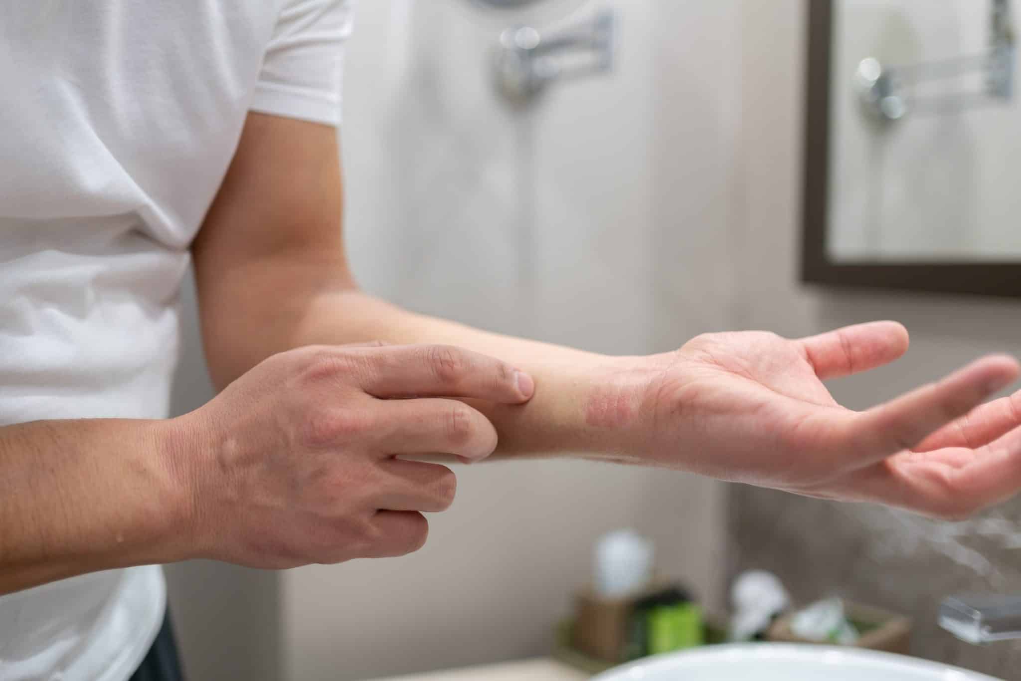 best atopic eczema cream, cream for atopic dermatitis, ingredients for eczema cream, snail mucin for eczema, Best Atopic Eczema Cream,