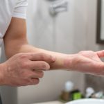 atopic dermatitis on hands,