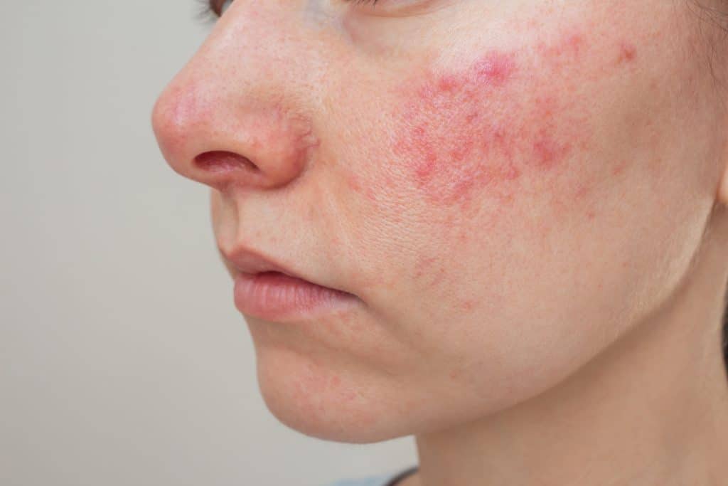 perioral dermatitis, skin rash around mouth, facial rash treatment Ireland, perioral dermatitis causes, gentle skin care for rash, Best Skincare for Perioral Dermatitis, dermatitis on the face,