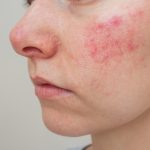 Best Skincare for Perioral Dermatitis, dermatitis on the face,
