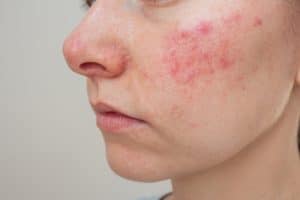 Best Skincare for Perioral Dermatitis, dermatitis on the face,