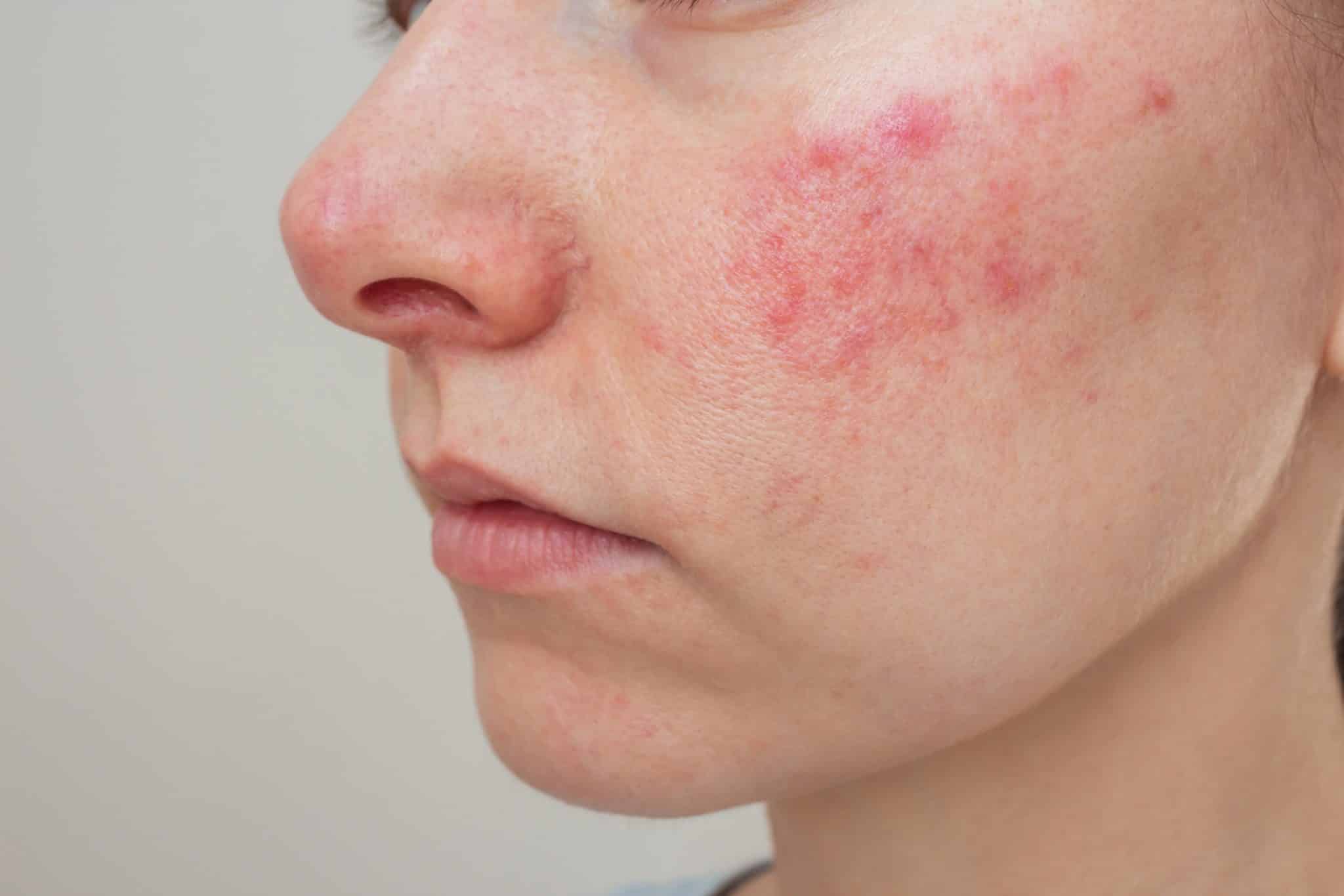 Best Skincare for Perioral Dermatitis, dermatitis on the face,