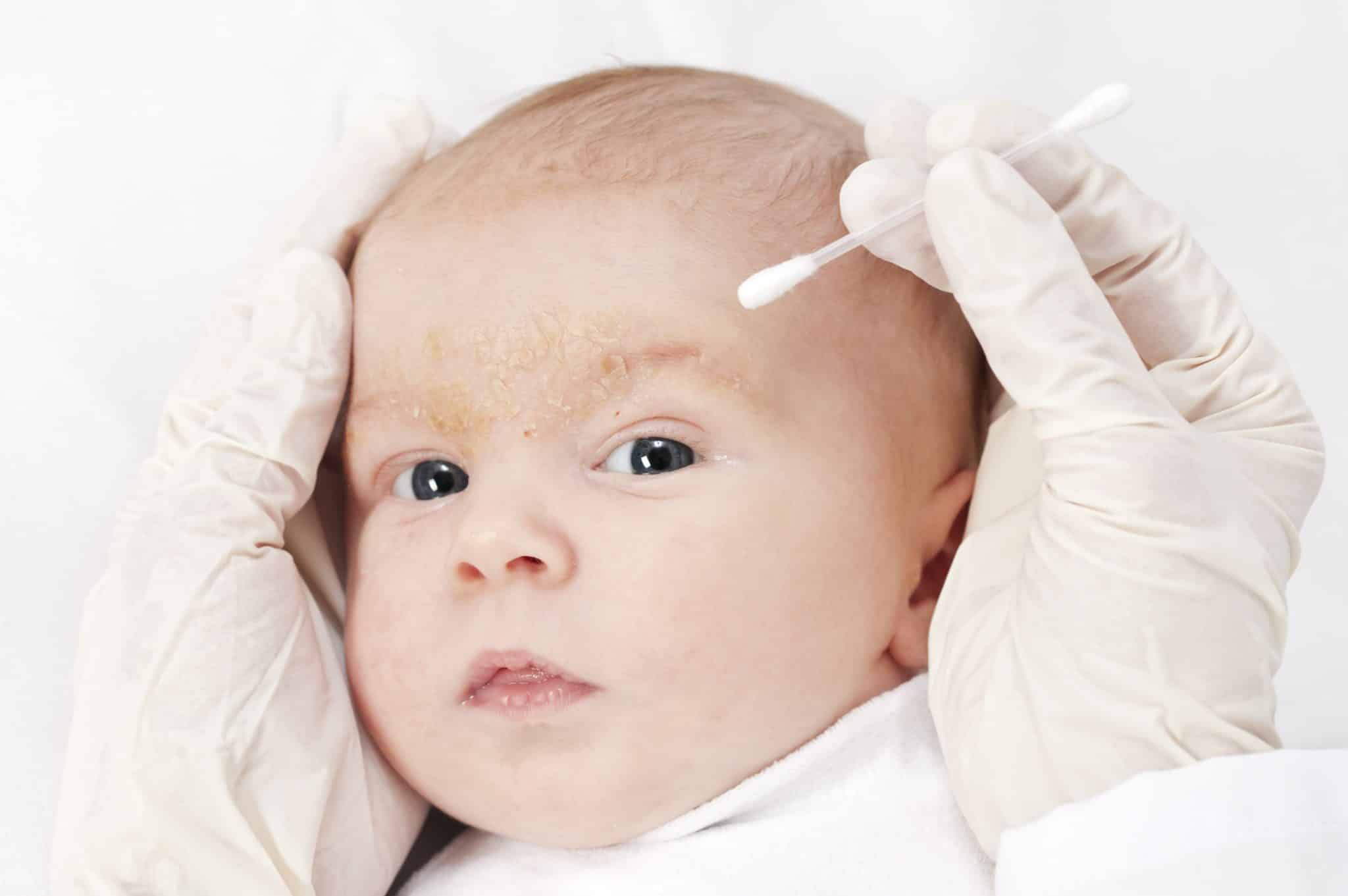 Best Atopic Dermatitis Creams,