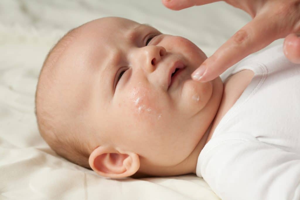 cream fo atopic dermatitis,