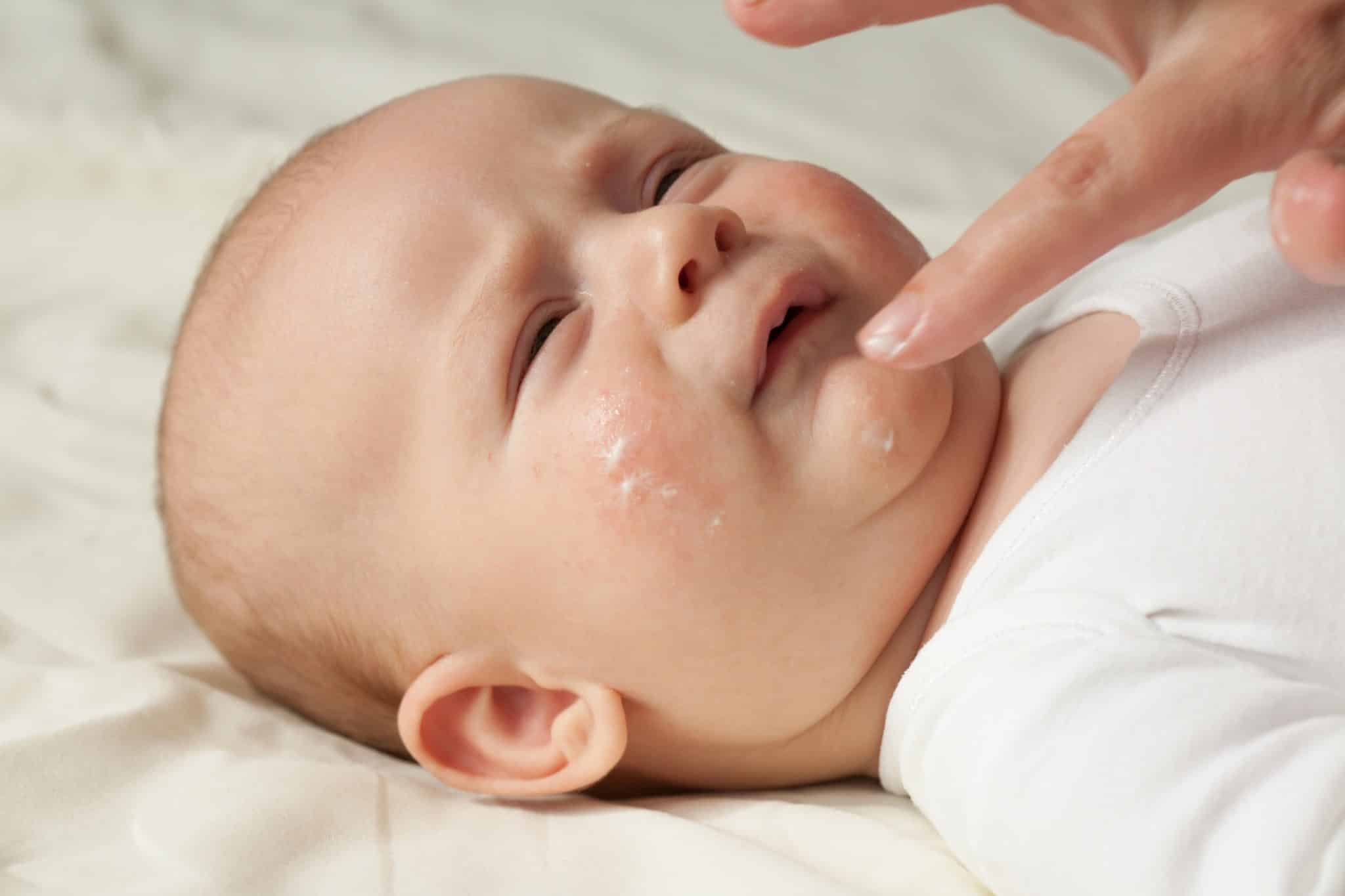 cream for atopic dermatitis,