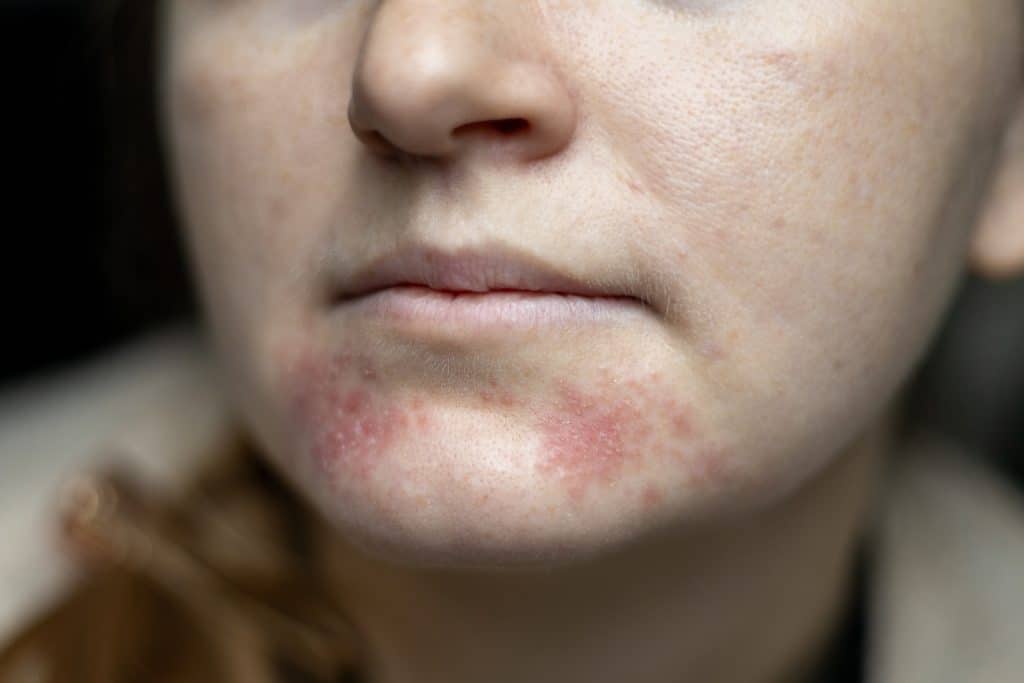 ​face eczema, eczema on face, facial eczema treatment, causes of face eczema, best cream for face eczema, Eczema Flare-Up on Face