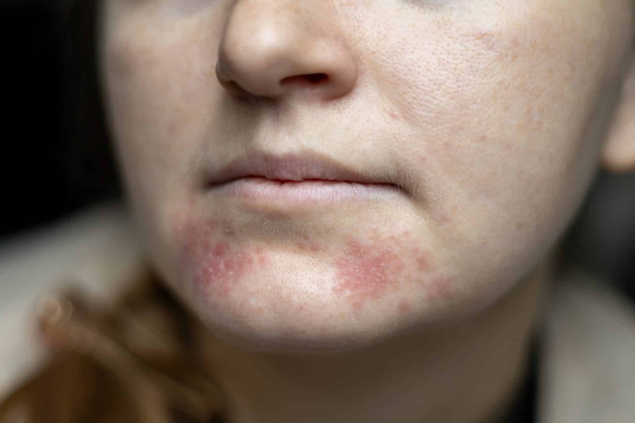 best atopic dermatitis cream, Eczema Flare-Up on Face