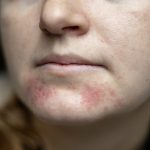 dermatitis on chin, dermatitis on face,