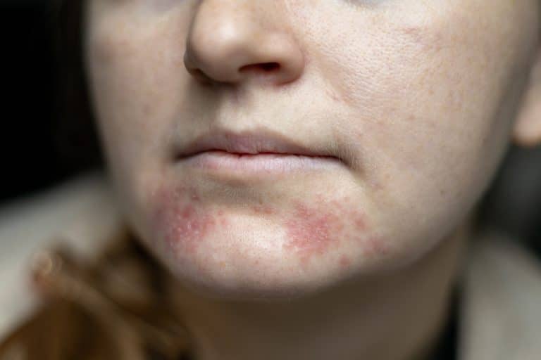 dermatitis on chin, dermatitis on face,