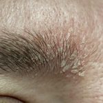 dermatitis care, dermatitis on face,