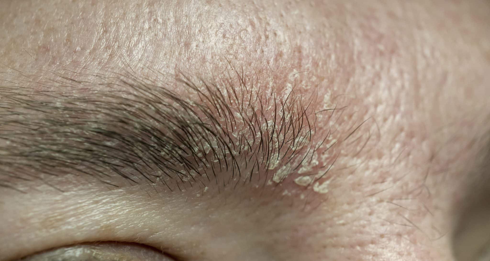 dermatitis care, dermatitis on face,