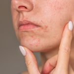 perioral dermatitis around the mouth