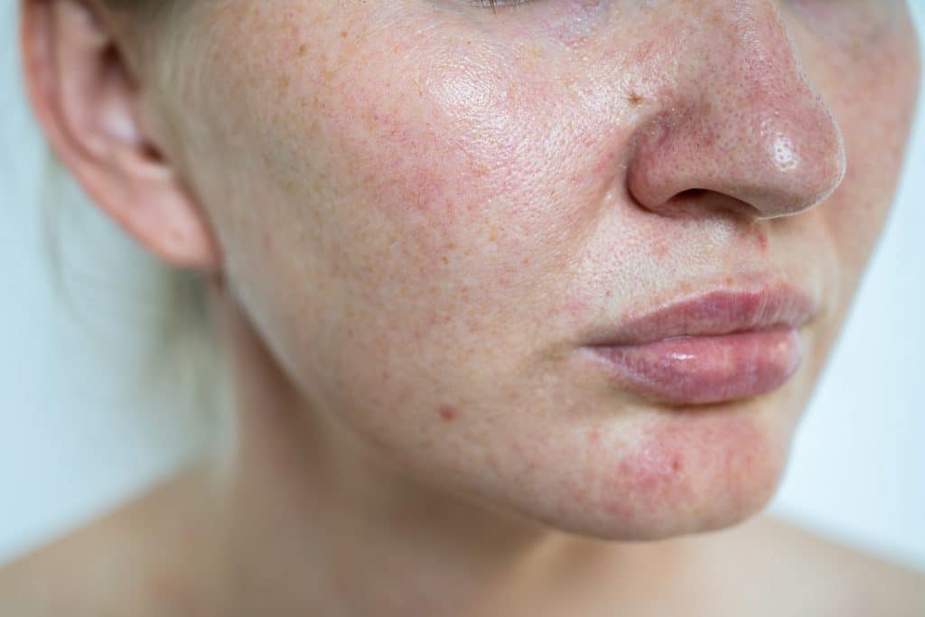 ​facial dermatitis, face rash treatment, skin irritation face, eczema on face, facial redness causes, Facial Dermatitis.