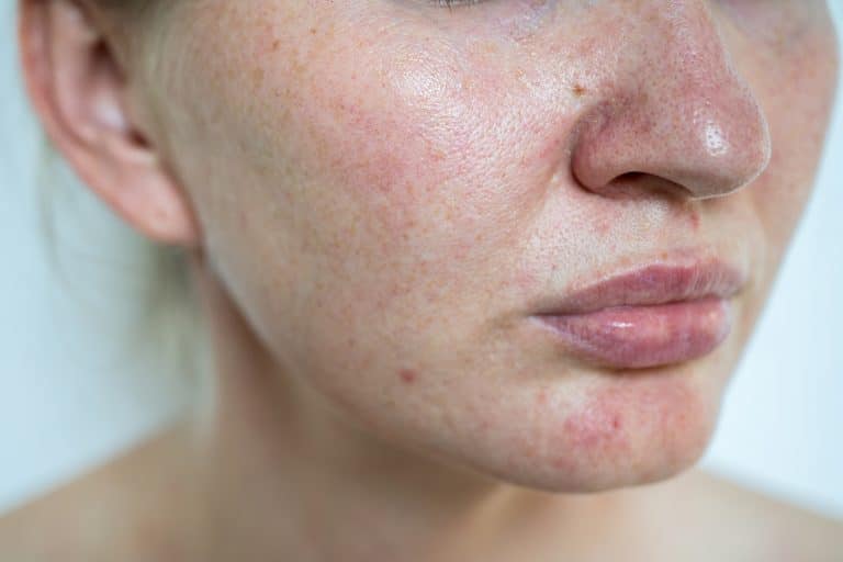 Facial Dermatitis.