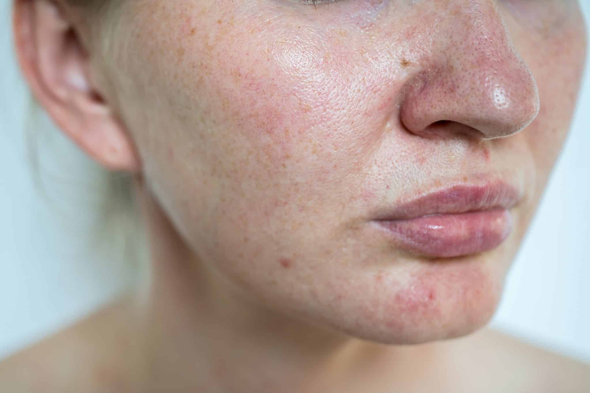 Facial Dermatitis.