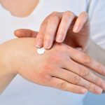 best hand cream for eczema, Treatment for Eczema Without Steroids, best hand cream for eczema