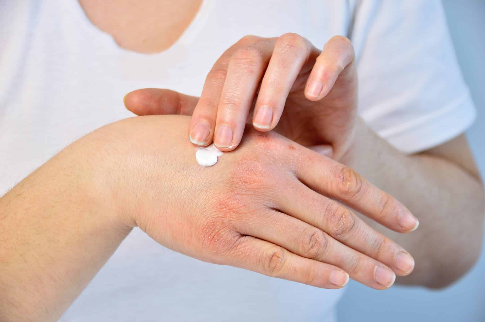 best hand cream for eczema, Treatment for Eczema Without Steroids, best hand cream for eczema