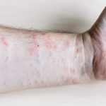 allergic reaction rash, Treatment for Dry and Itchy Skin