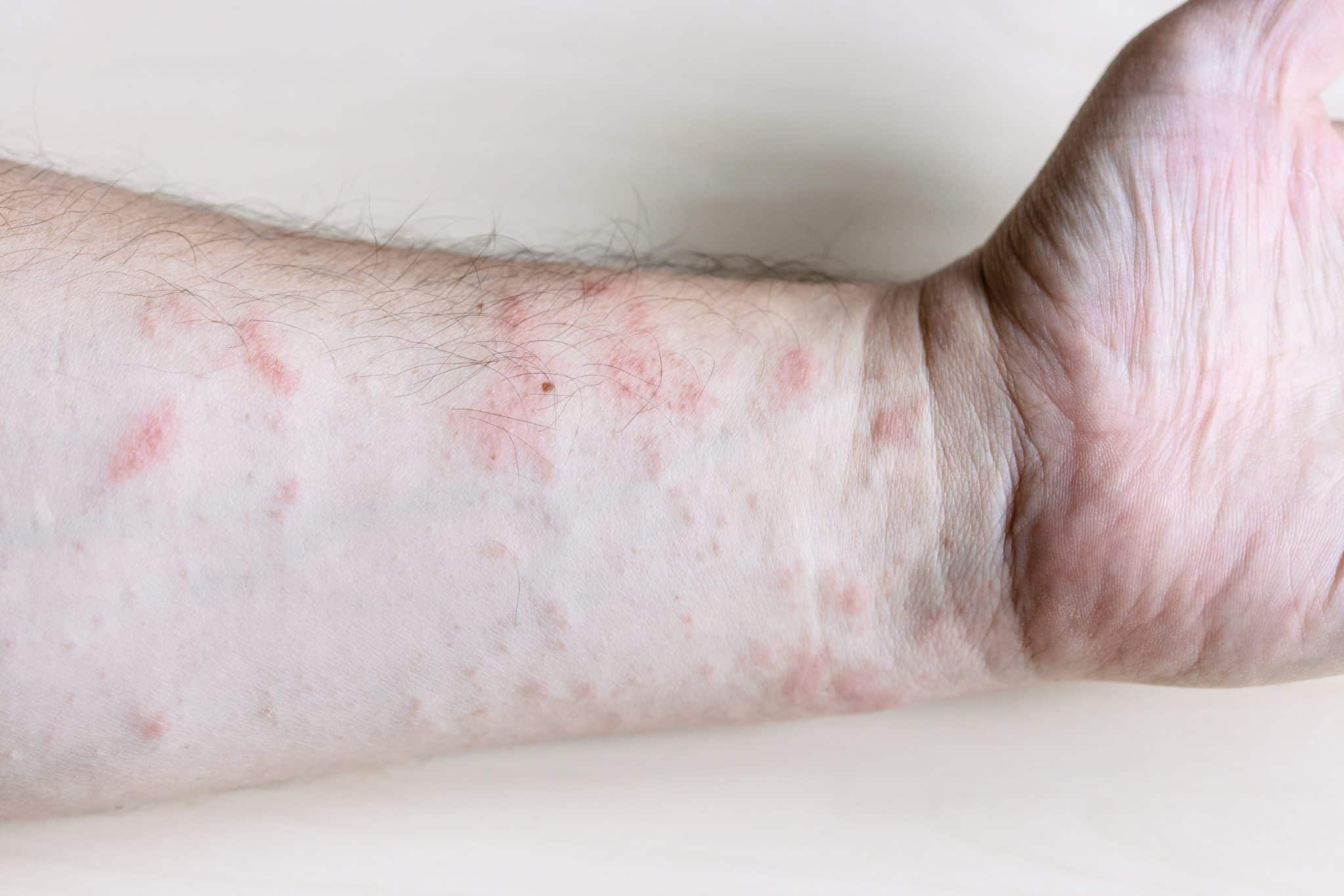 allergic reaction rash, Treatment for Dry and Itchy Skin