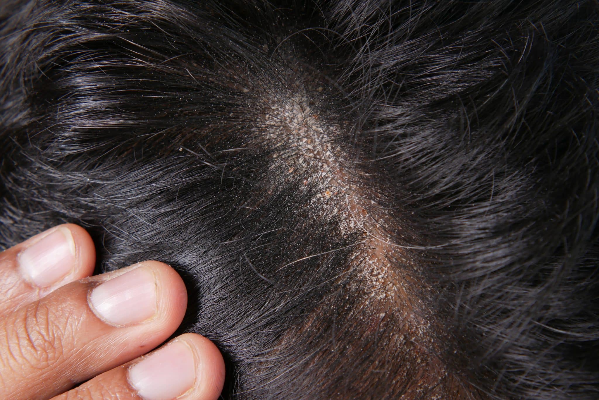 scalp psoriasis shampoo, psoriasis relief shampoo, medicated shampoo for scalp psoriasis, anti-itch shampoo for psoriasis, best shampoo for flaky scalp, shampoo for psoriasis on scalp,