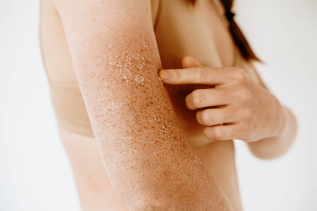 Dry Sun Damaged Forehead, The Best Lotion for Sun Damaged Skin,