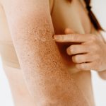 Dry Sun Damaged Forehead, The Best Lotion for Sun Damaged Skin,