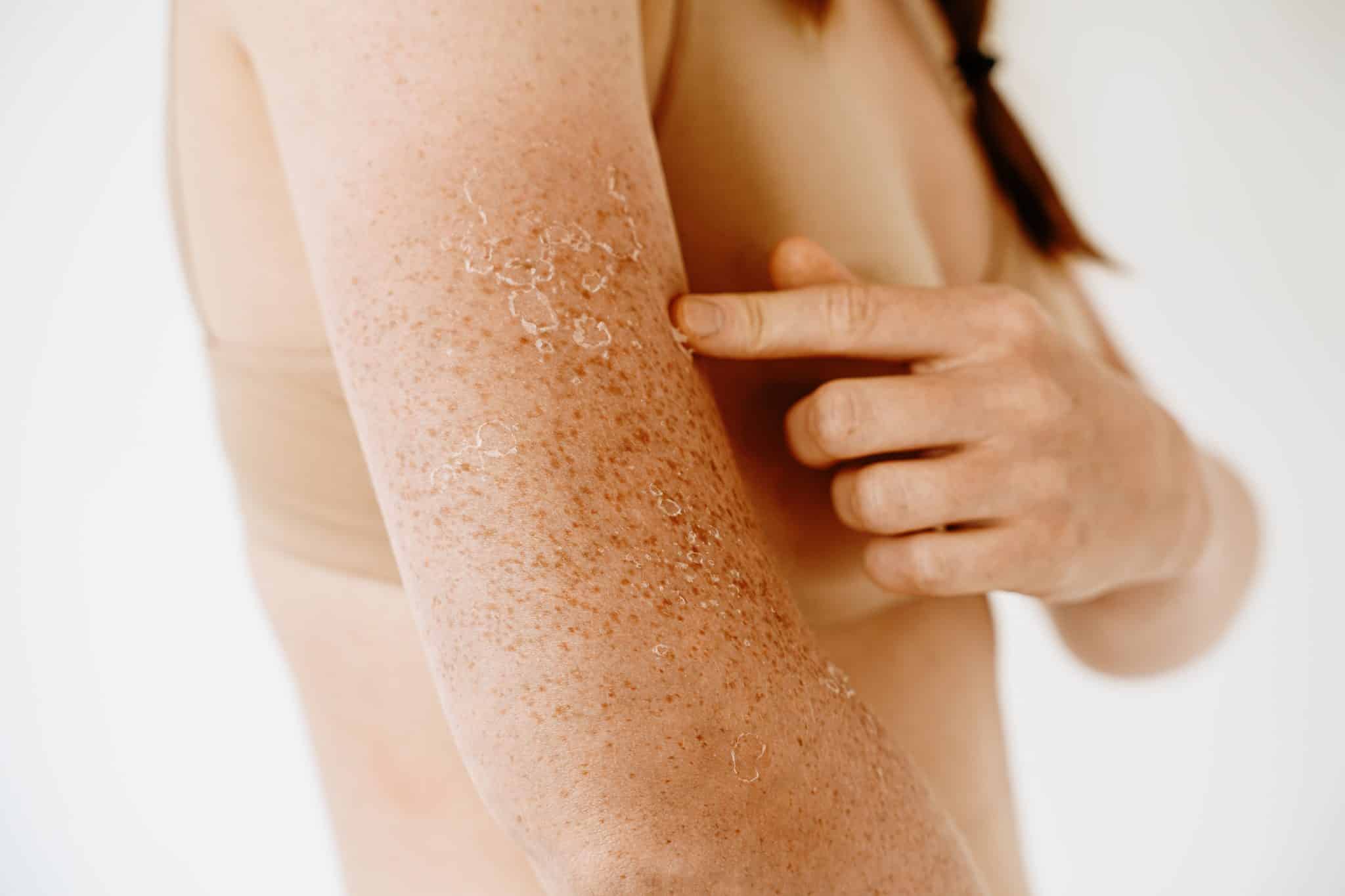Dry Sun Damaged Forehead, The Best Lotion for Sun Damaged Skin,