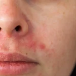 perioral dermatitis nose