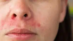 perioral dermatitis nose