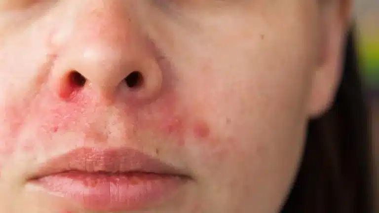 perioral dermatitis nose