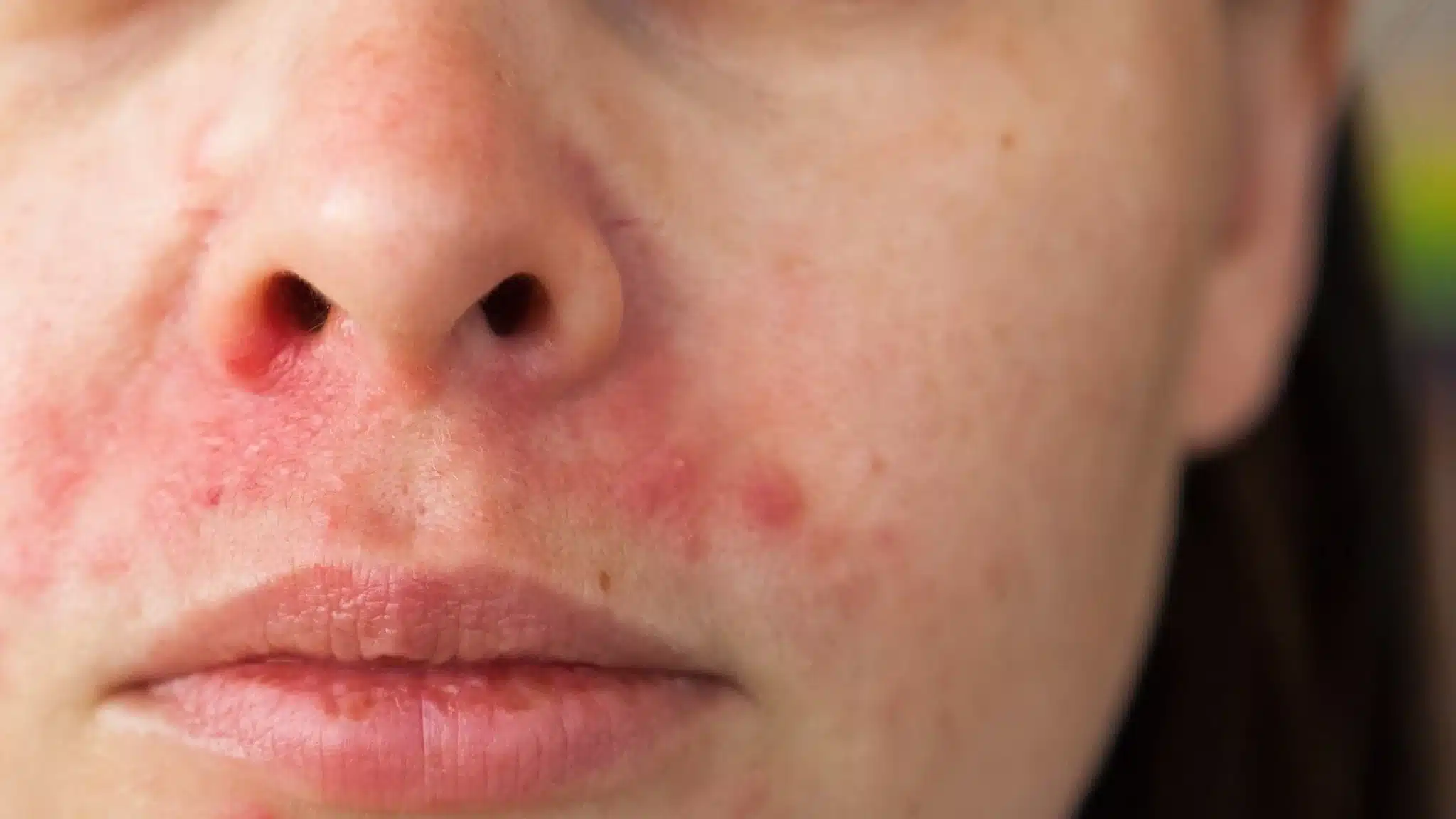 perioral dermatitis nose