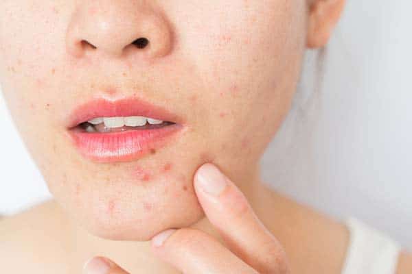 perioral dermatitis, skin rash around mouth, facial rash treatment Ireland, perioral dermatitis causes, gentle skin care for rash, perioral dermatitis,